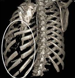 Traumi del Torace: la Chirurgia Toracica dell’Ospedale di Baggiovara tra i centri con la casistica più ampia in Europa