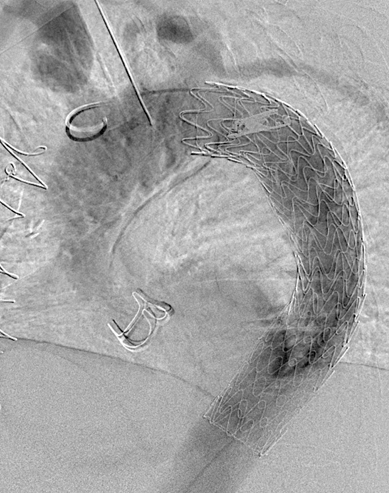 Angiografia finale dopo posizionamento di endoprotesi toracica: risultato in sala ibrida nel 2020 