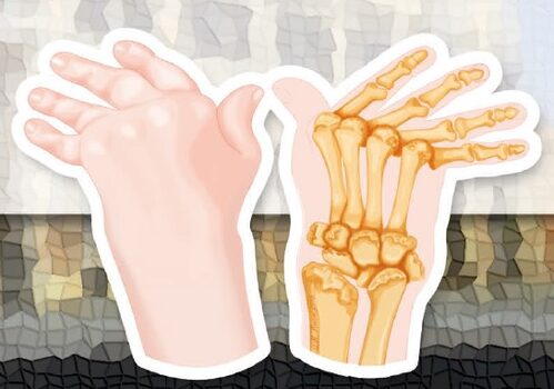 Malattie reumatiche del polso e della mano