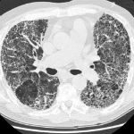 La lotta alla Fibrosi Polmonare Idiopatica